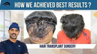 Hair Transplant In Bangalore | Best Center Surgeon & hospital Of Hair Transplant In Bangalore