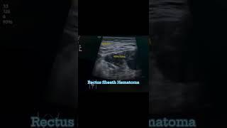 Rectus sheath hematoma#imaging #ultrasound #medicalimaging #learning #medicine #viral #doctor