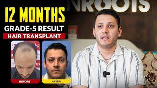 Hair Transplant Journey: From Grade 5 Baldness to Full Hair | Best Cost & Results of Hair Transplant