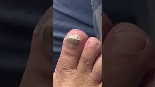 Creams don’t work for toenail fungus #podiatry #footcare #toenailfungus #feet #toenails