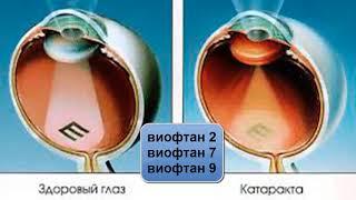 КАТАРАКТА  Применение флуревитов при различных видах Катаракты