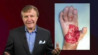 Severed Fingers & Extreme Arm Injuries. Plastic Surgery Hot Topics with Rod J. Rohrich, MD