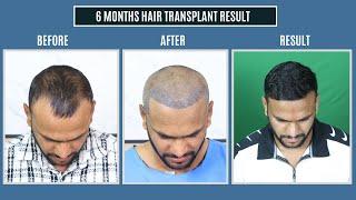 Hair Transplant in Indore | Cost of Hair Transplant in Indore | Hair Transplant Doctor in Indore