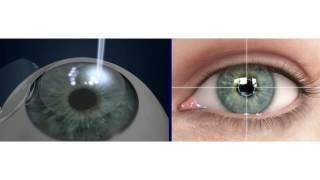 Dr. Bucci Addresses LASIK Fears