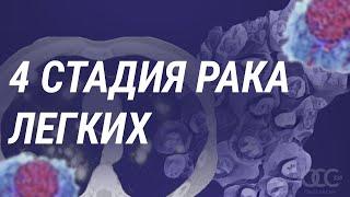 4 стадия рака легких. Как жить дальше?