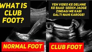 Club foot deformity ultrasound | how to diagnose | learn ultrasound | #radiology  #clubfoot #fetal