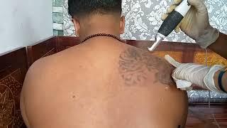 Proses menghapus TATO permanen