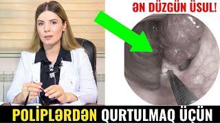 Endometrial polip necə çıxarılır? HiSTERESKOPİYA sonrası qanama!