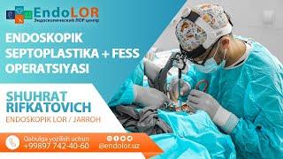 Эндоскопическая Септопластика + FESS / Endoskopik Septoplastika + FESS operatsiyasi @shuhratlor