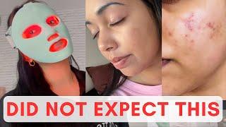 Non Sponsored LED mask review - before and after!  - QURE infrared light therapy 