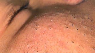 The Ultimate Facial Mask: Blackhead Removal and Acne Treatment Tips