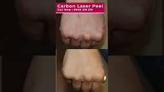 Never Underestimate The Influence Of Carbon Laser Peel For Hand. #carbonlaserforhan #skinaaclinic