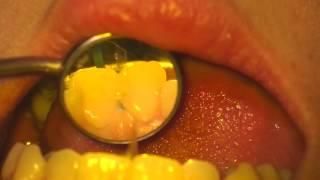 Filling Cavities in the Front Teeth