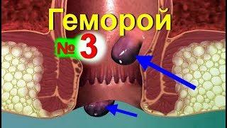 Лечение геморроя в домашних условиях. Как лечить геморрой народными средствами. Как убрать боль