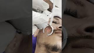 Unveil Your True Beauty: CO2 Scar Removal - Quick & Effective Results