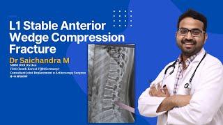 L1 Stable Anterior Wedge Compression Fracture..Dr Sai Chandra MBBS DNB Ortho