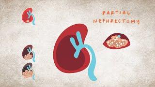 Kidney Cancer Surgeries & Procedures | National Kidney Foundation