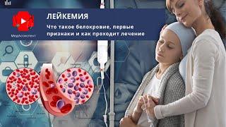 Лейкемия. Симптомы рака крови и основные методы лечения