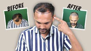 Hair Transplant in Bhopal | Cost of Hair Transplant in Bhopal | Hair Transplant Doctor in Bhopal