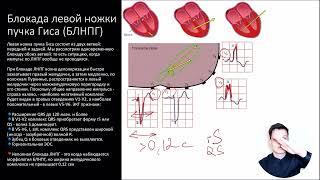 ЭКГ за 100 минут №5: Нарушение проводимости на ЭКГ