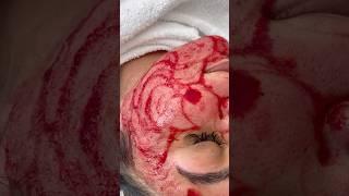 Microneedling Vampire Behandlung bei Esmerella Studio Cosmetics Braunschweig