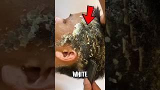 What’s REALLY Hiding in Dandruff? Under the Microscope ️