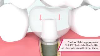 BioHPP: neue Dimension in der prothetischen Versorgung von Implantaten