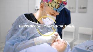 Верхняя блефаропластика, этапы операции, результат через 3 месяца | Андрей Ковынцев