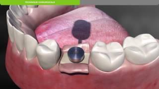 Biotech Dental :Protocole chirurgical de pose d'un implant dentaire KONTACT sous-crestal