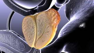 Prostate Cancer Animation