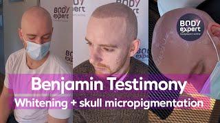 DENTAL CARE AND MICROPIGMENTATION |  Benjamin's testimony : skull micropigmentation | BODYEXPERT