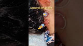 Conquering Migraine pain and treatment #migraine #cuppingtherapy #headache #pain #cupping #hijama