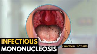 Infectious mononucleosis, Causes, Signs and Symptoms, Diagnosis and Treatment.