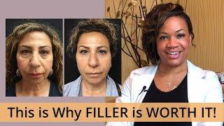 Is FILLER WORTH IT? [ Cosmetic Physician Injector Weighs In]