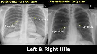 Normal Chest X-Ray Labelled Anatomy PA View Part 1: CXR Interpretation| Ribs/Heart/Lungs Radiography