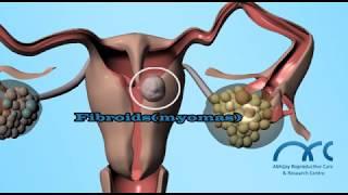 Hysterosalpingogram Procedure | Hysterosalpingogram Video - ARC Chennai