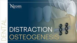 NEOM Clinic: Distraction Osteogenesis - Innovative Dental Solutions