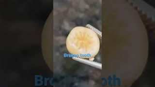 How we will extract Broken tooth|Extraction of tooth|Dentistry lifeUr smile is Important to us