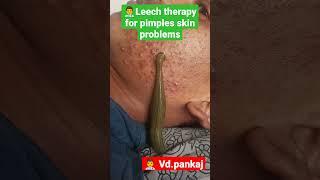 leech therapy for skin problems #pimples #ayurveda #skinproblems #shorts #panchkarma #hairfall #mp