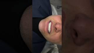 Композитные виниры. Без обточки. Москва. Санкт-петербург. Стамбул. Dr. Gussoeva