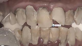 Can You Watch Till the End? Top 3 Most Shocking Tartar Removals!#139