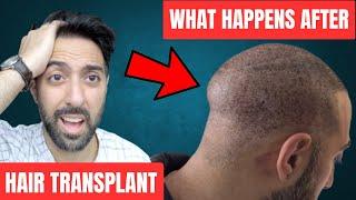 6 Struggles after a Hair Transplant (what to expect)