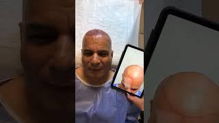 Sapphire FUE hair Transplant by TAS TEAM at Tas Hair Clinic Istanbul, Turkey