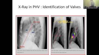 Prosthetic Heart Valve by Dr. Md. Azizur Rahman Roman sir