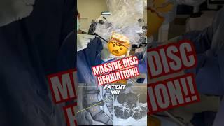MASSIVE Disc Herniation Surgery