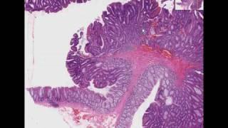 Histopathology Colon --Tubular adenoma (adenomatous polyp)