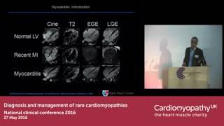 When to suspect myocarditis