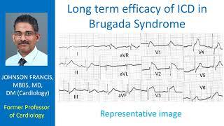 Long term efficacy of ICD in Brugada Syndrome