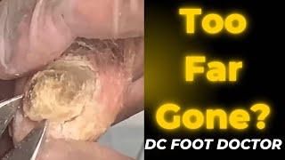 Too Far Gone?: Severe Fungal Toenails