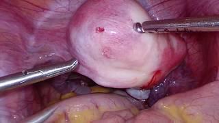 Dr Modi's Myomectomy small fibroid Turned ? Focal adenomyosis & hysteroscopy 28/12/2019